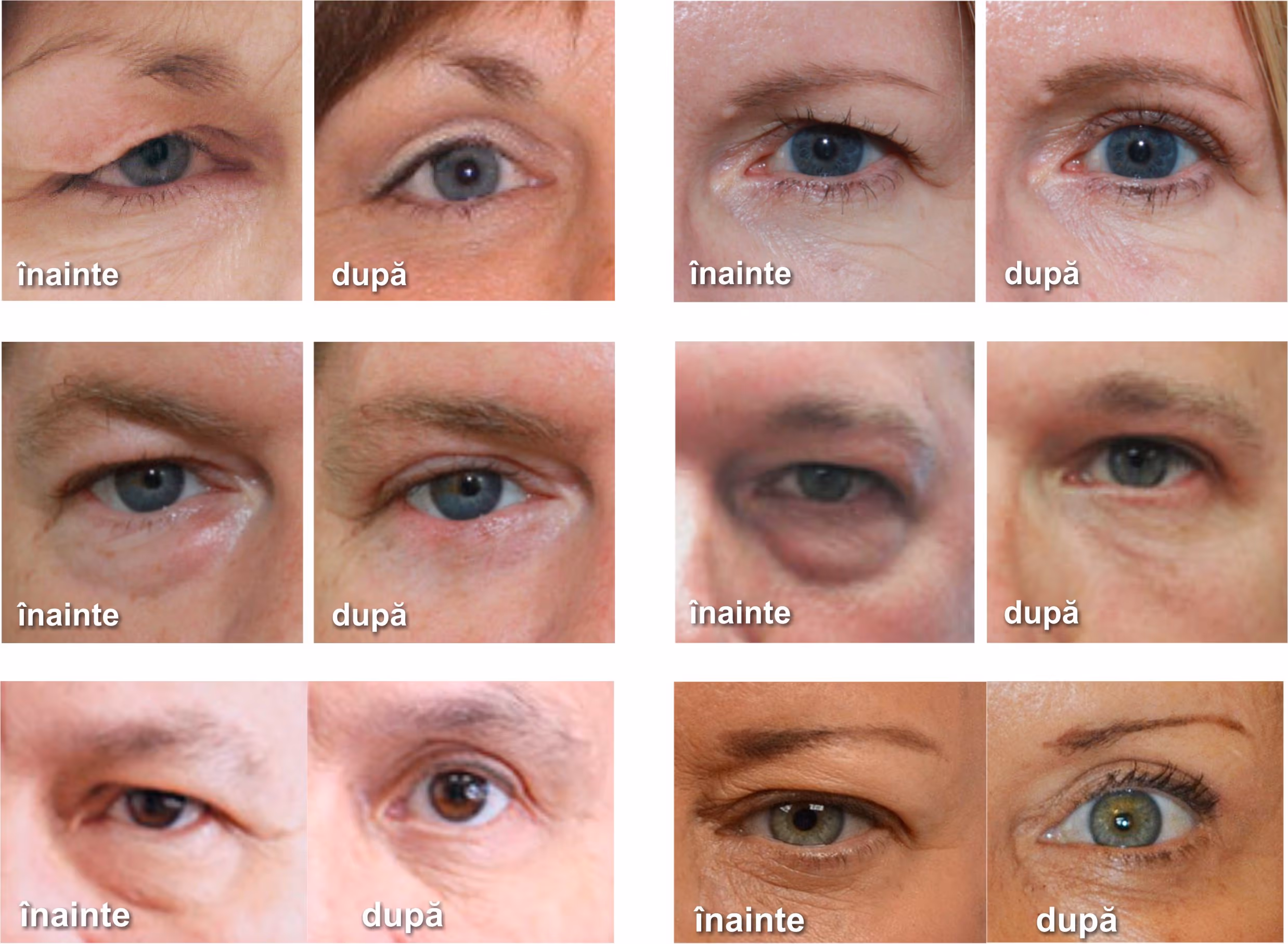 Blefaroplastia