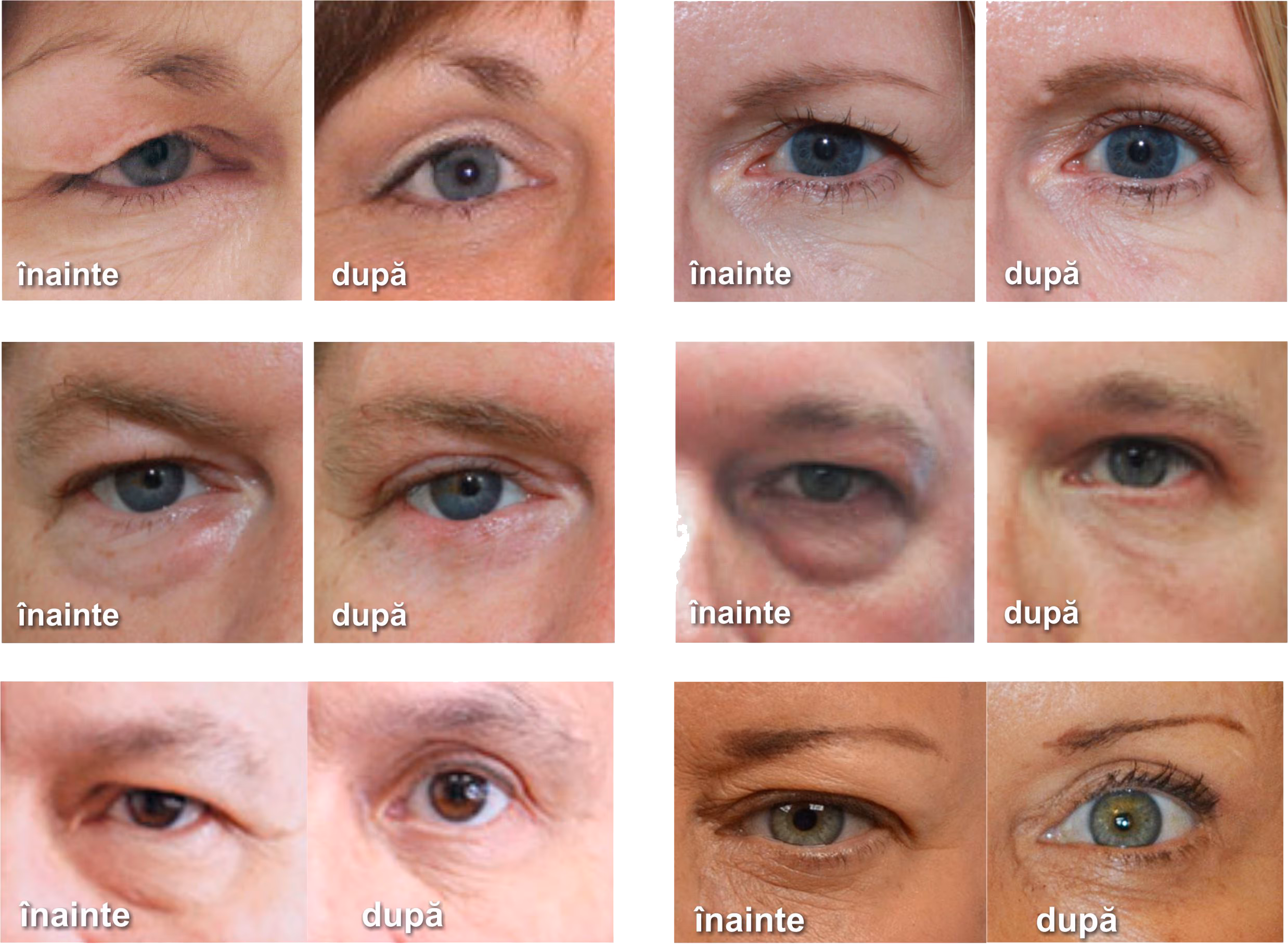 Blefaroplastii superioare si inferioare