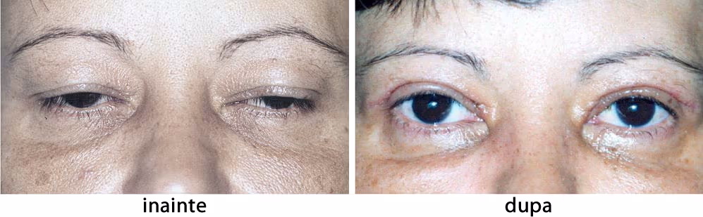 Dermatosalazis