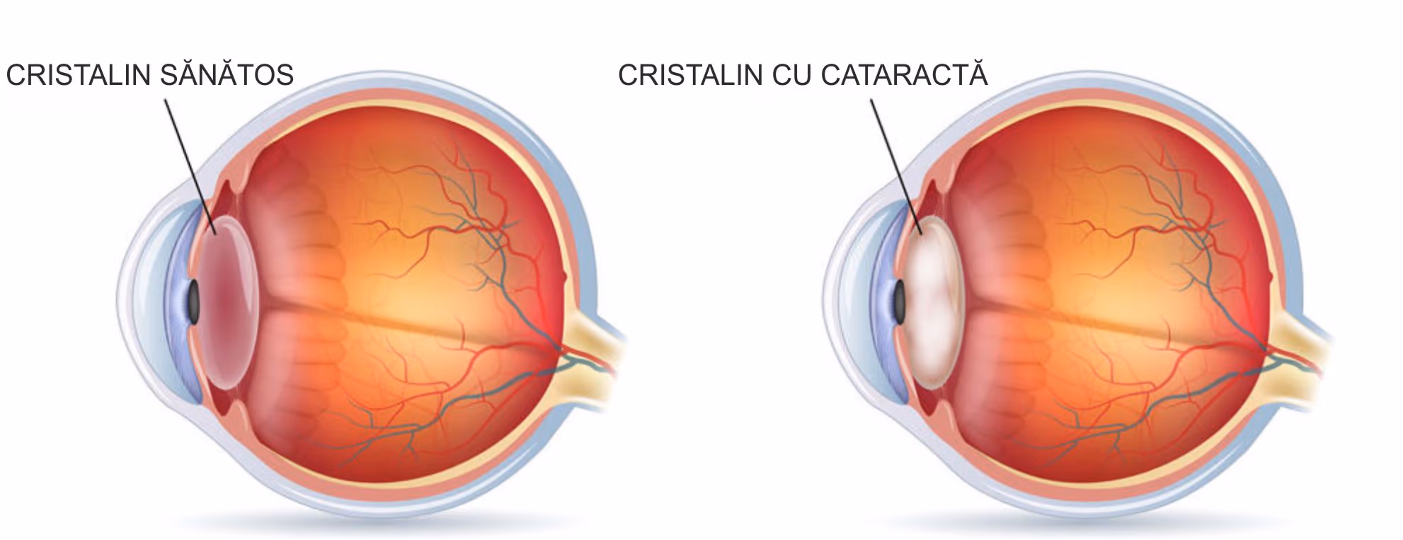 Cristalinul ochiului