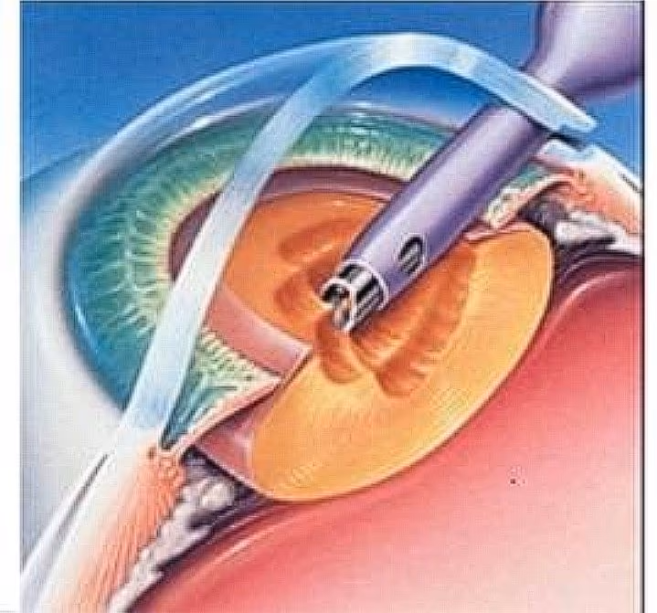 Emulsificarea cristalinului opacifiat cu ultrasunete