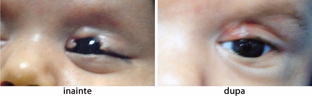 Colobom palpebral congenital